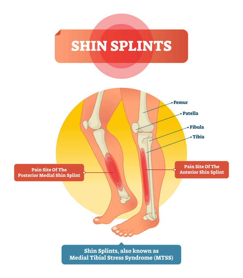shin splints