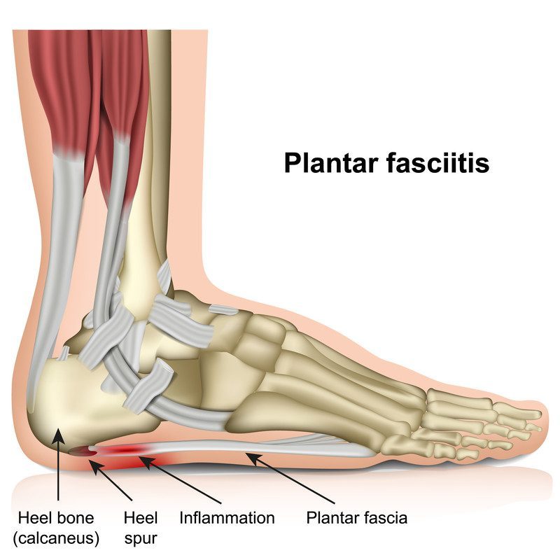 plantar fasciitis