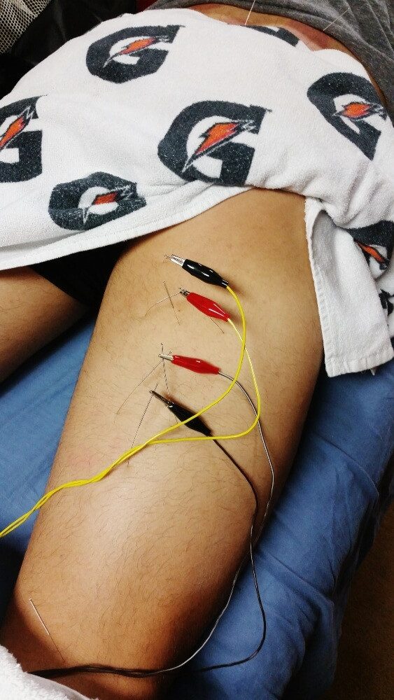 Acupuncture