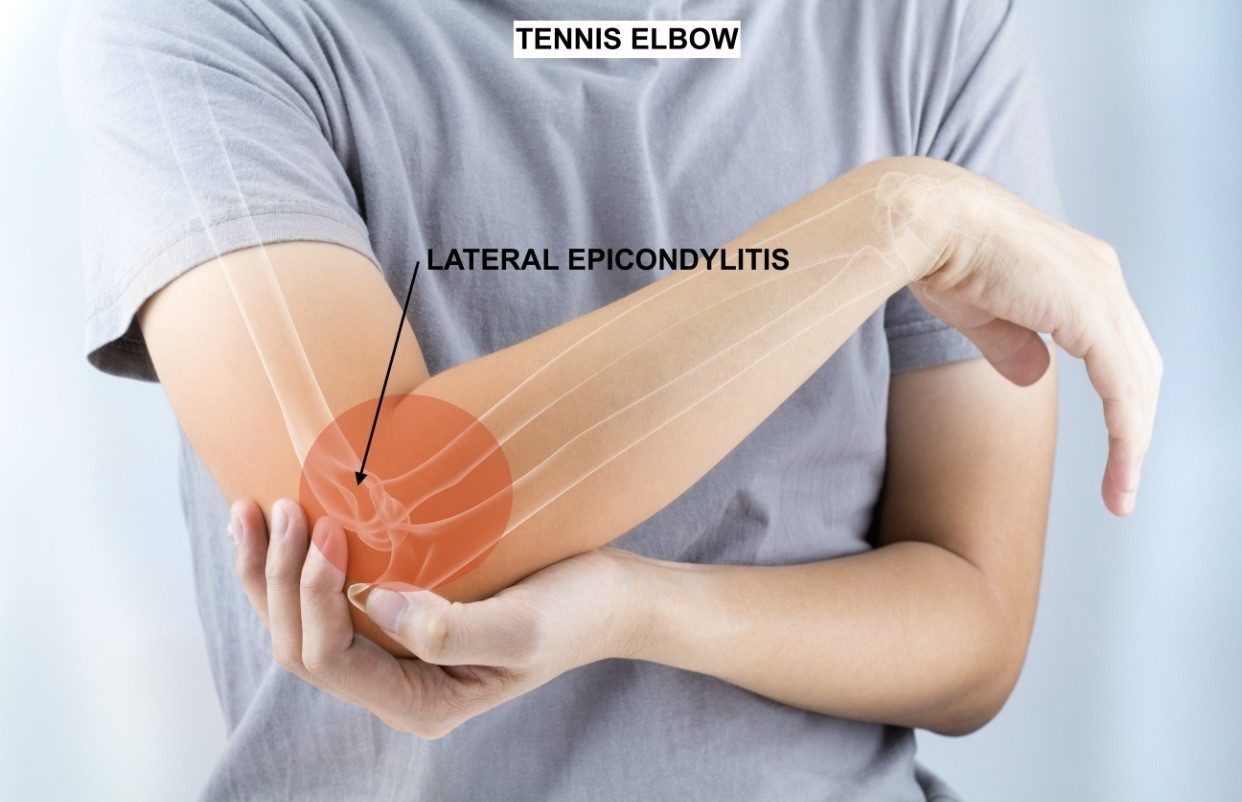 Tennis Elbow