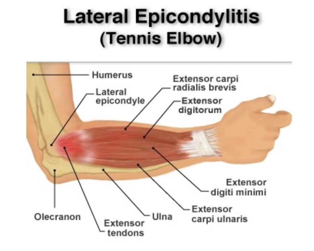 Lateral Epicondylitis